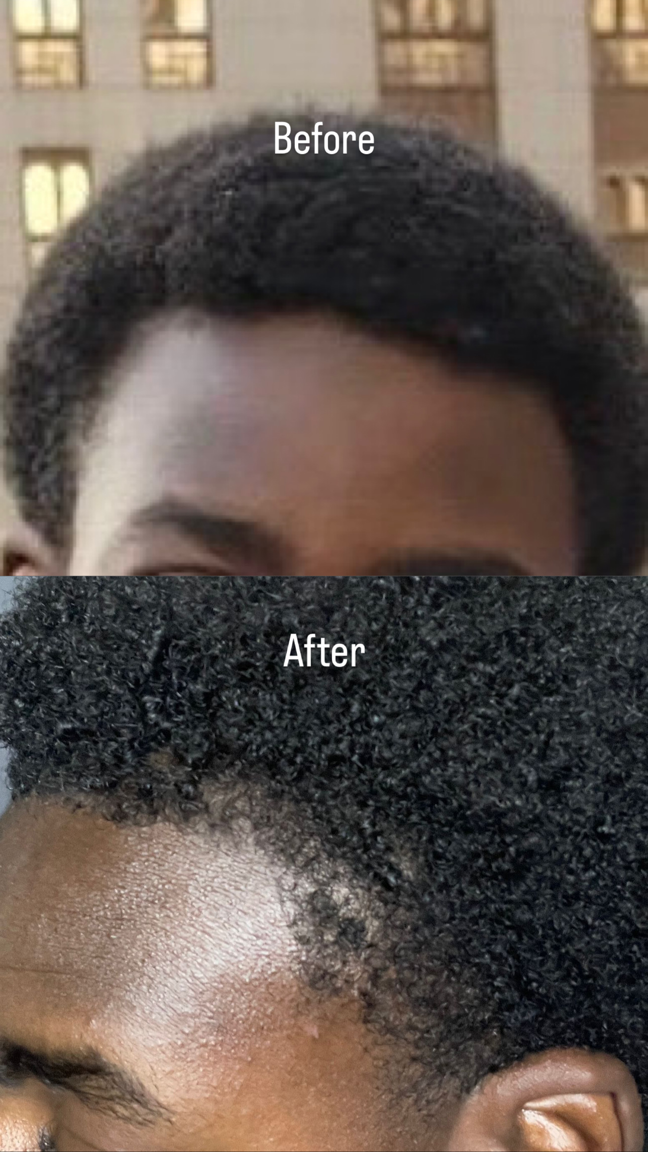 A before and after comparison showing hair growth on a boy's hairline